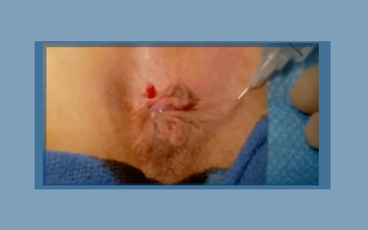 Hemorrhoid Surgery is the surgery to remove hemorrhoids.